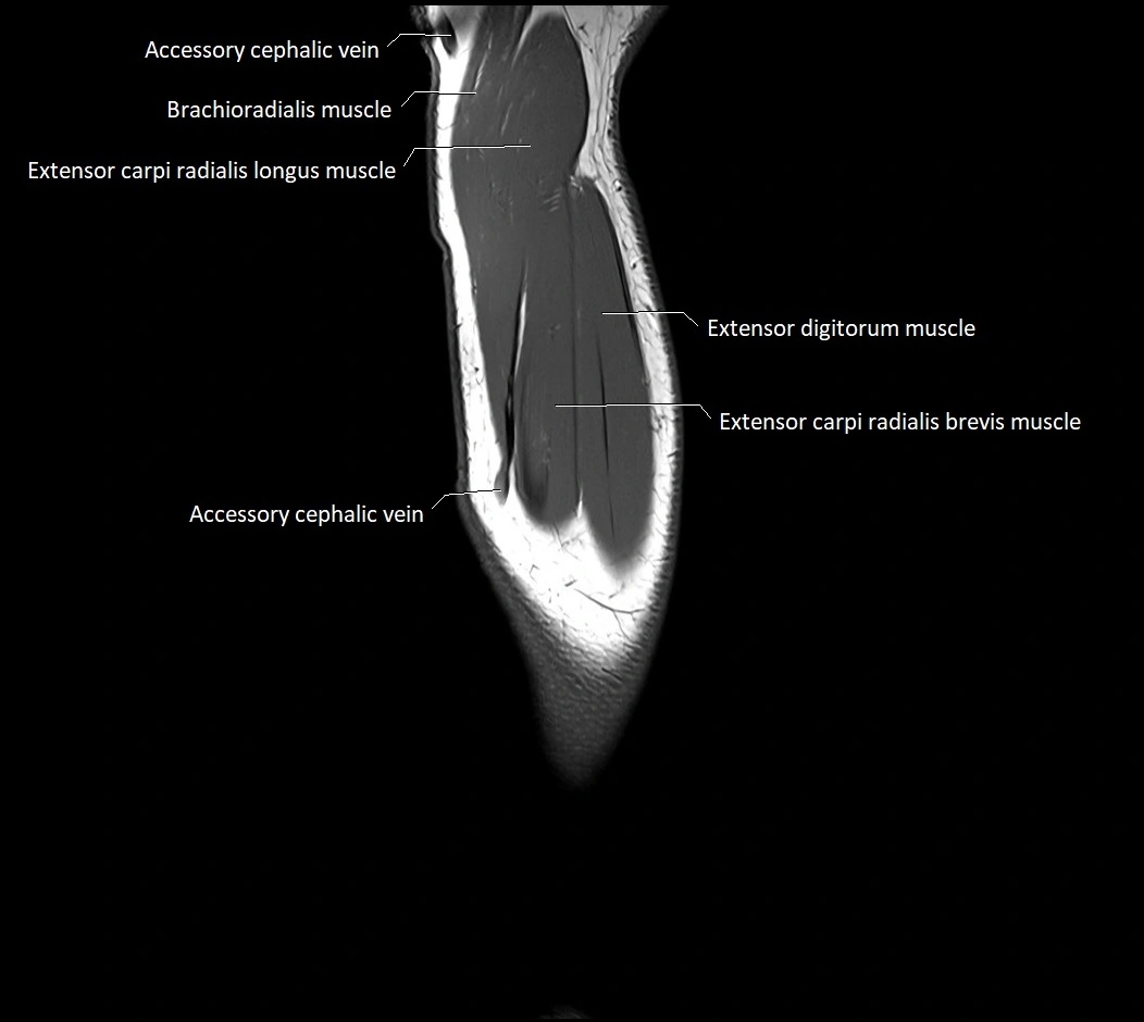 MRI 3T forearm sagittal labelled cross sectional anatomy image 7.webp
